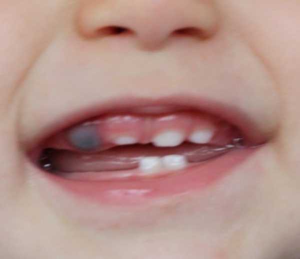 Как лезут зубки у малышей фото