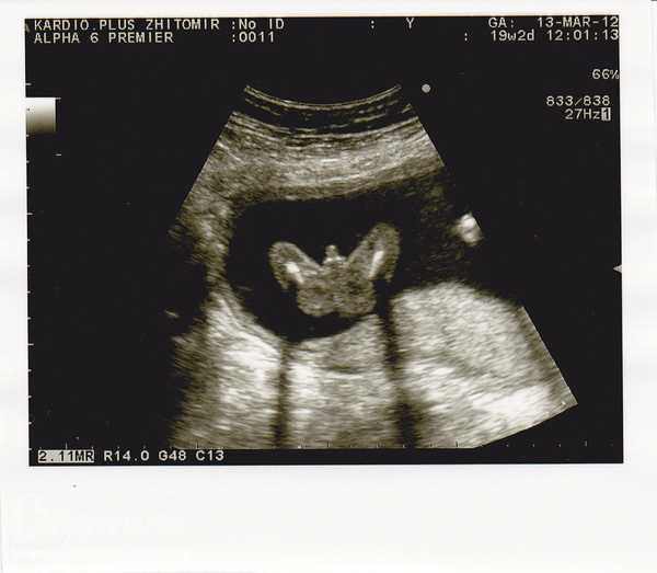 20 недель беременности фото малыша и вес плода