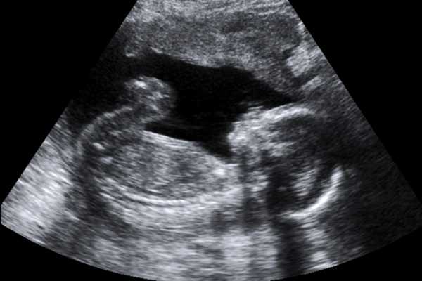 Узи ребенка 15 недель беременности фото