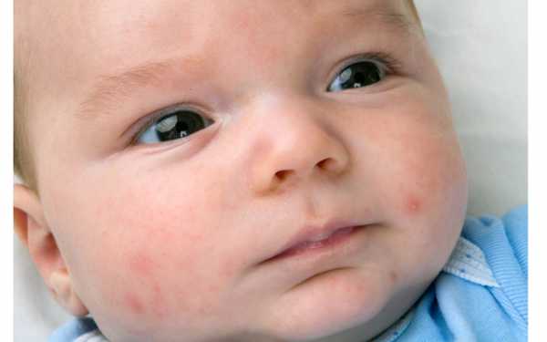 Сыпь на лице и на теле у ребенка фото с пояснениями