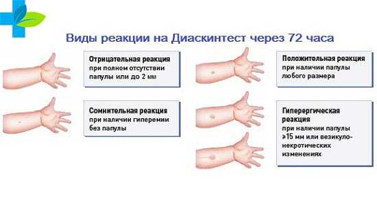 Манту и диаскинтест результаты фото