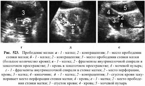 Выпадение матки у женщин после родов фото