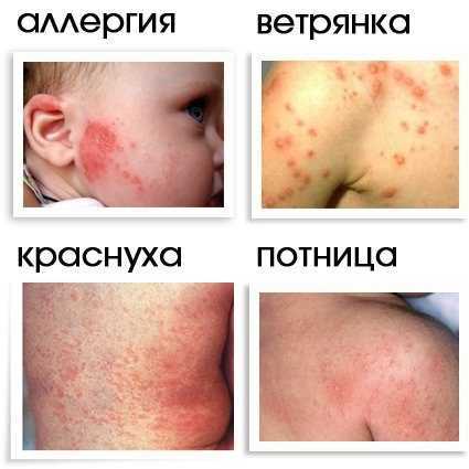 Инфекционные заболевания у детей фото