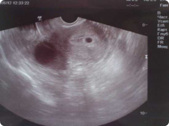 Беременность 4 недели видна на узи. УЗИ беременности на ранних сроках 4-5 недель. УЗИ беременности 4 недели беременности. 4 Недели беременности УЗИ 4 недели беременности. Беременность 4-5 недель фото эмбриона на УЗИ.