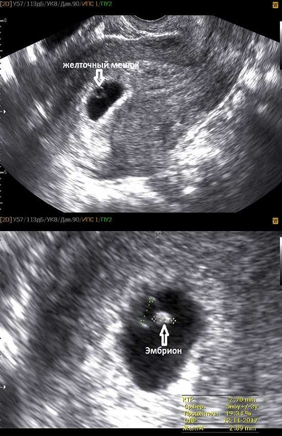 Как выглядит ребенок на 4 неделе беременности фото узи