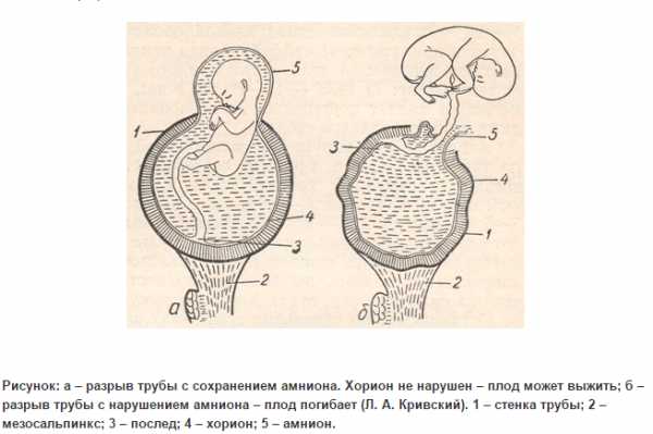 Клиническая картина внематочной беременности