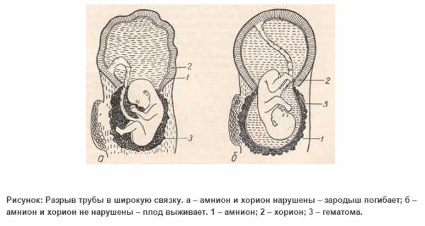 Где болит при внематочной беременности на ранних сроках картинки