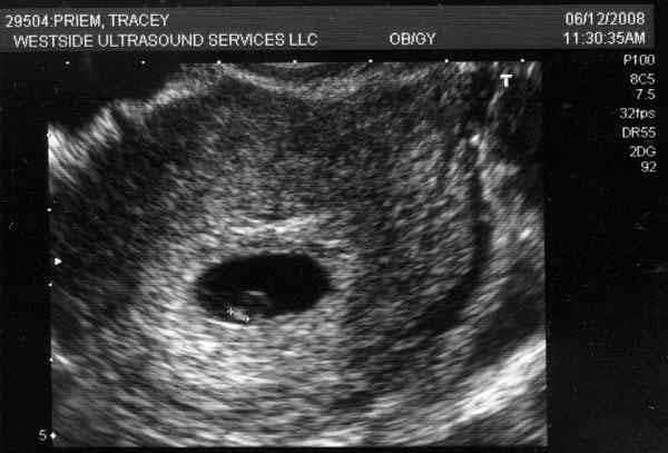 Узи плод 5 недель. Эмбрион на 5 акушерской неделе УЗИ. Эмбрион на 5 неделе беременности акушерской. Как выглядит эмбрион в 5 недель на УЗИ. Эмбрион на 5 неделе беременности УЗИ.