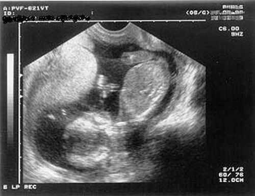 Узи фото в 16 недель беременности фото